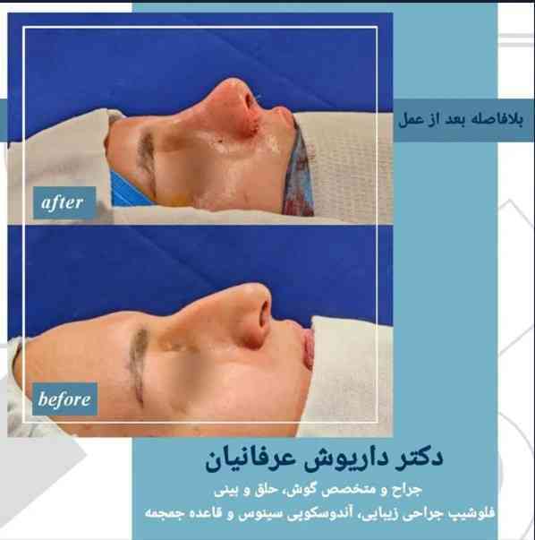 جراحی بینی استخوانی در مشهد