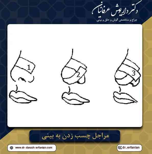 چسب زدن به بینی بعد از جراحی