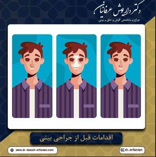 اقدامات قبل از جراحی بینی