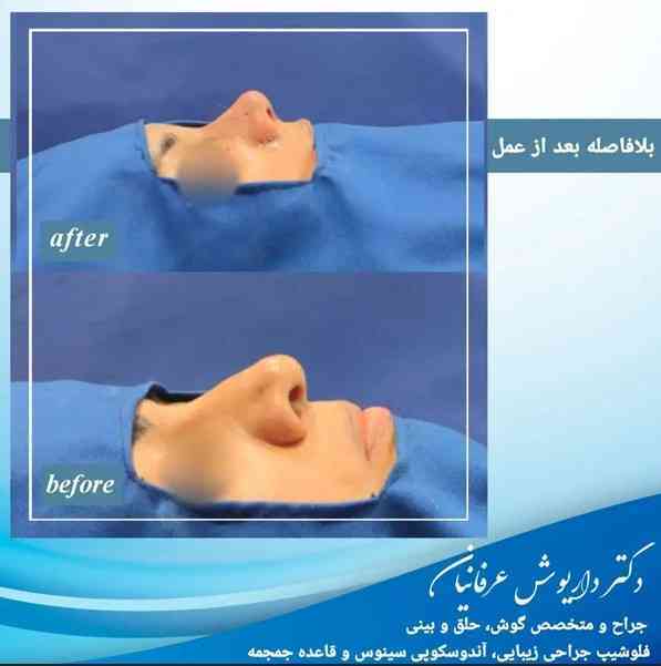 جراحی بینی باز