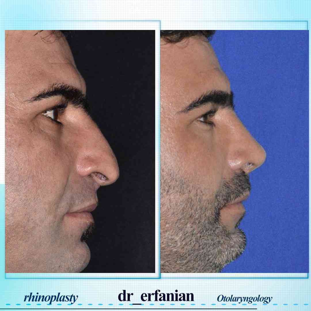 عمل ترمیمی بینی