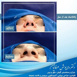جراحی-بینی-در-مشهد479