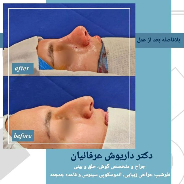 جراحی بینی - دکتر عرفانیان