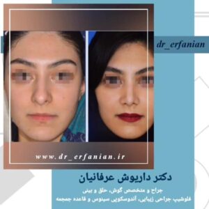 جراحی بینی بسته در مشهد - دکتر عرفانیان