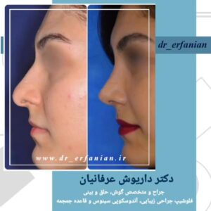جراحی بینی بسته در مشهد - دکتر عرفانیان