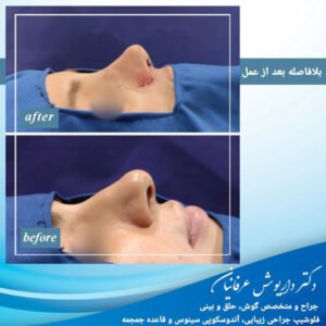 جراحی ترمیمی بینی در مشهد - دکتر عرفانیان