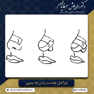 چسب زدن به بینی 