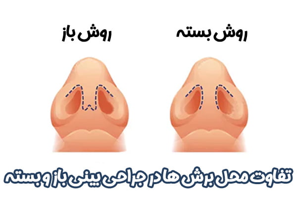 جراحی بینی باز در مشهد - دکتر عرفانیان