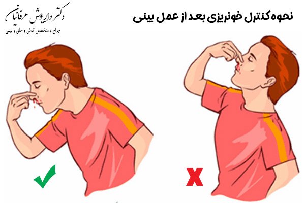 عوارض جراحی بینی - دکتر عرفانیان