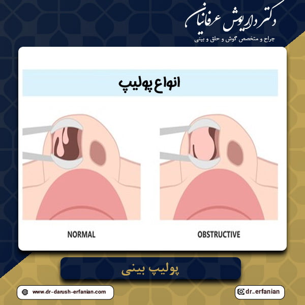 درمان پولیپ بینی در مشهد - دکتر عرفانیان