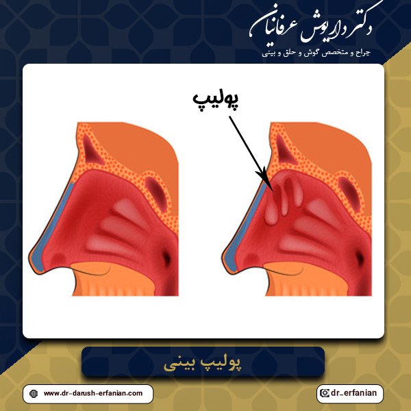 درمان پولیپ بینی در مشهد - دکتر عرفانیان