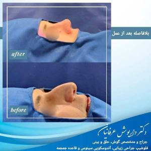 بهترین جراح بینی استخوانی مشهد - دکتر عرفانیان