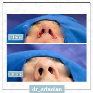 جراحی بینی استخوانی در مشهد - دکتر عرفانیان
